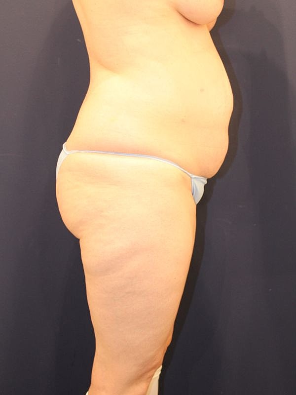 Tummy Tuck Gallery Before & After