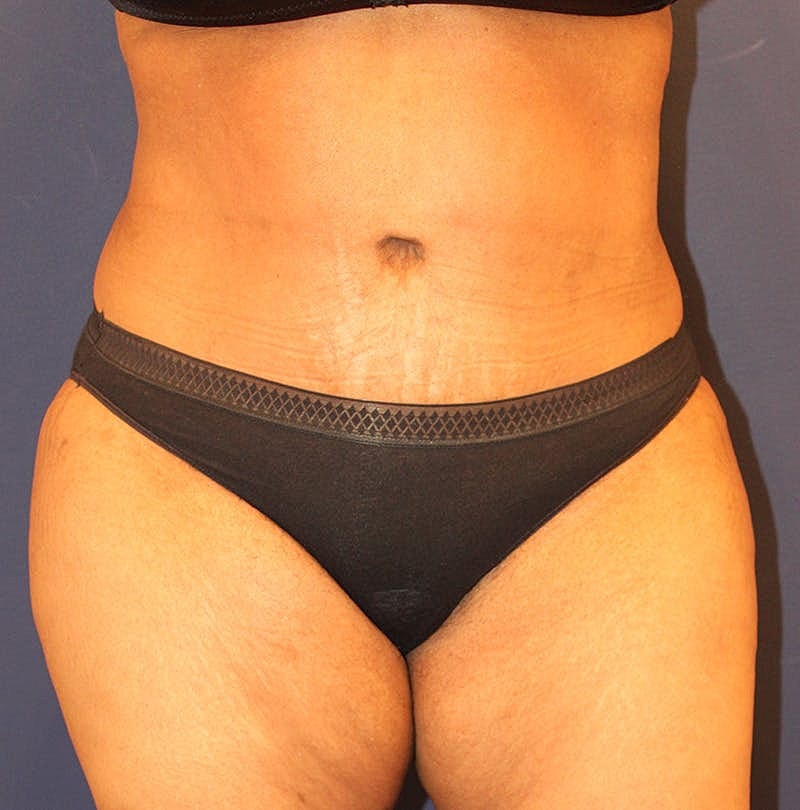 Tummy Tuck Before & After