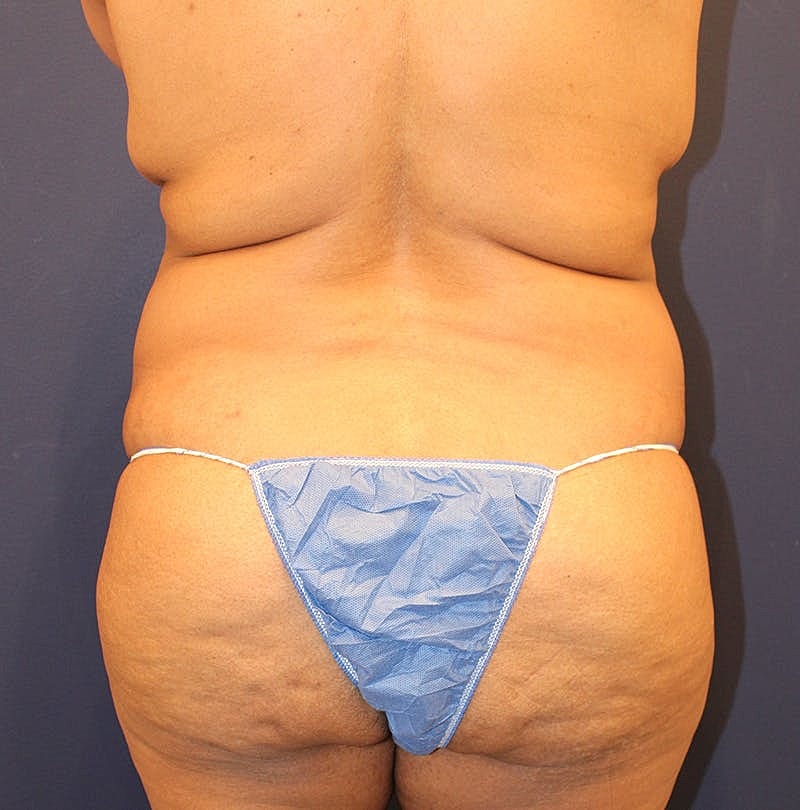 Tummy Tuck Before & After