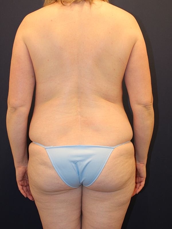 Tummy Tuck Gallery Before & After