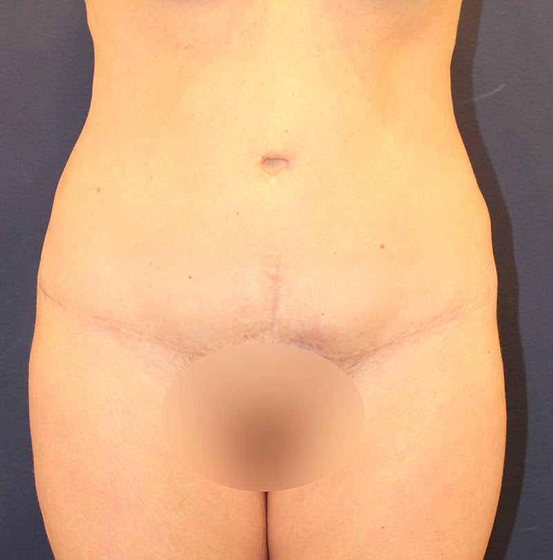 Tummy Tuck Before & After