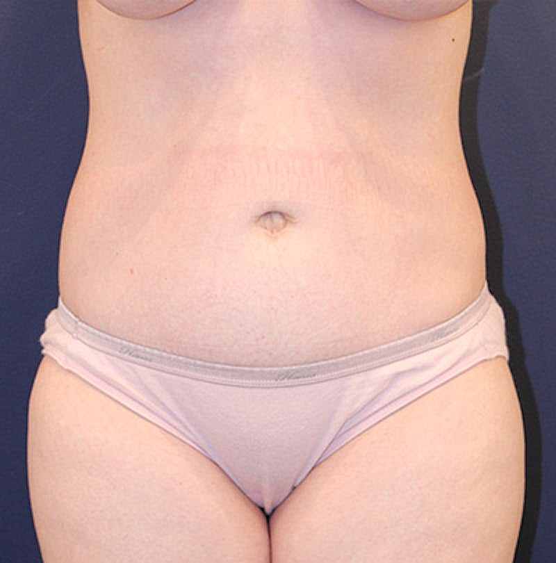 Tummy Tuck Before & After