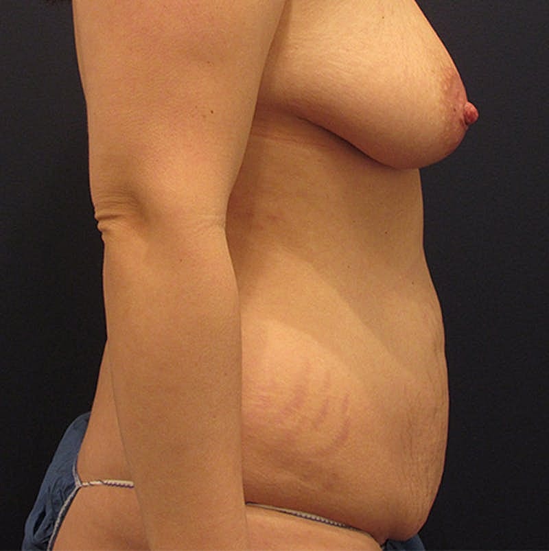 Tummy Tuck Before & After