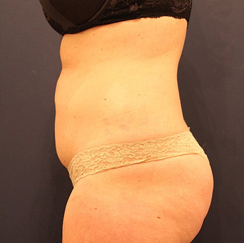 Tummy Tuck Before & After