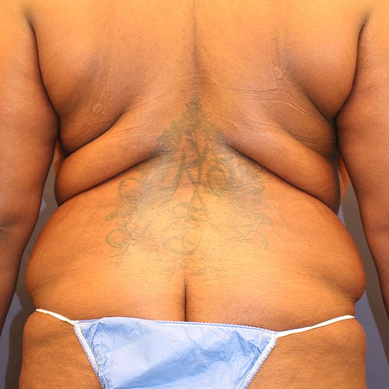 Tummy Tuck Before & After