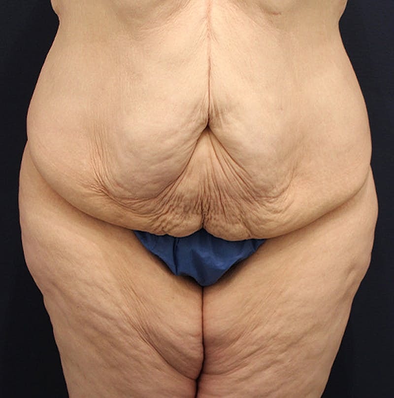Tummy Tuck Before & After