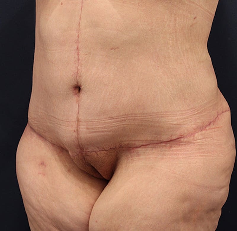 Tummy Tuck Before & After