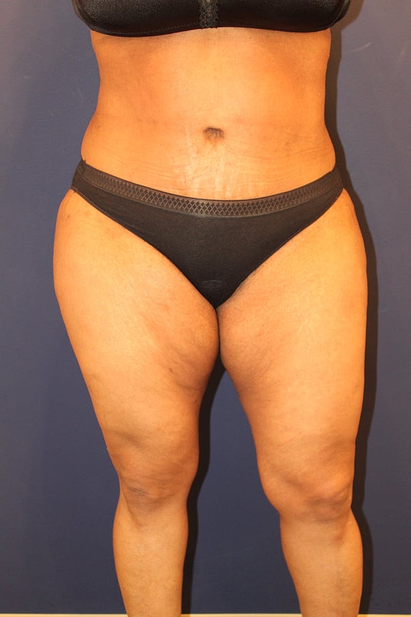 Tummy Tuck Before & After