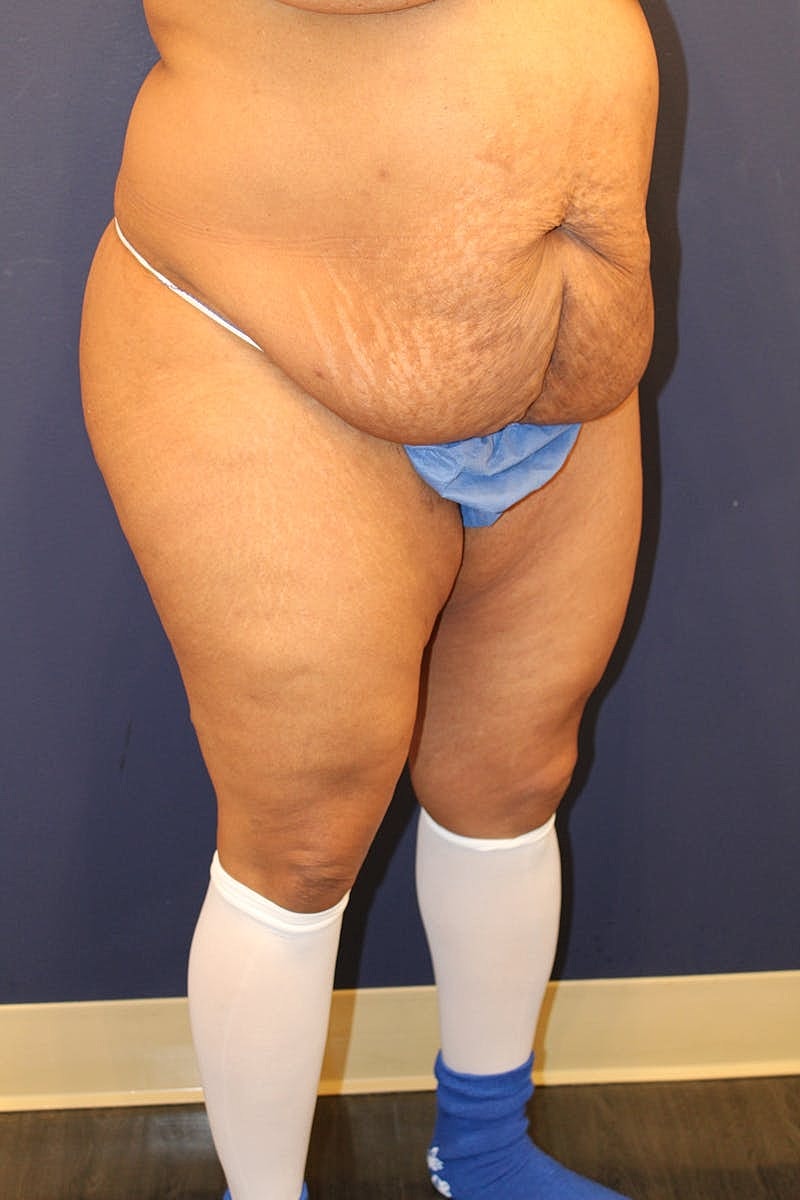 Tummy Tuck Before & After