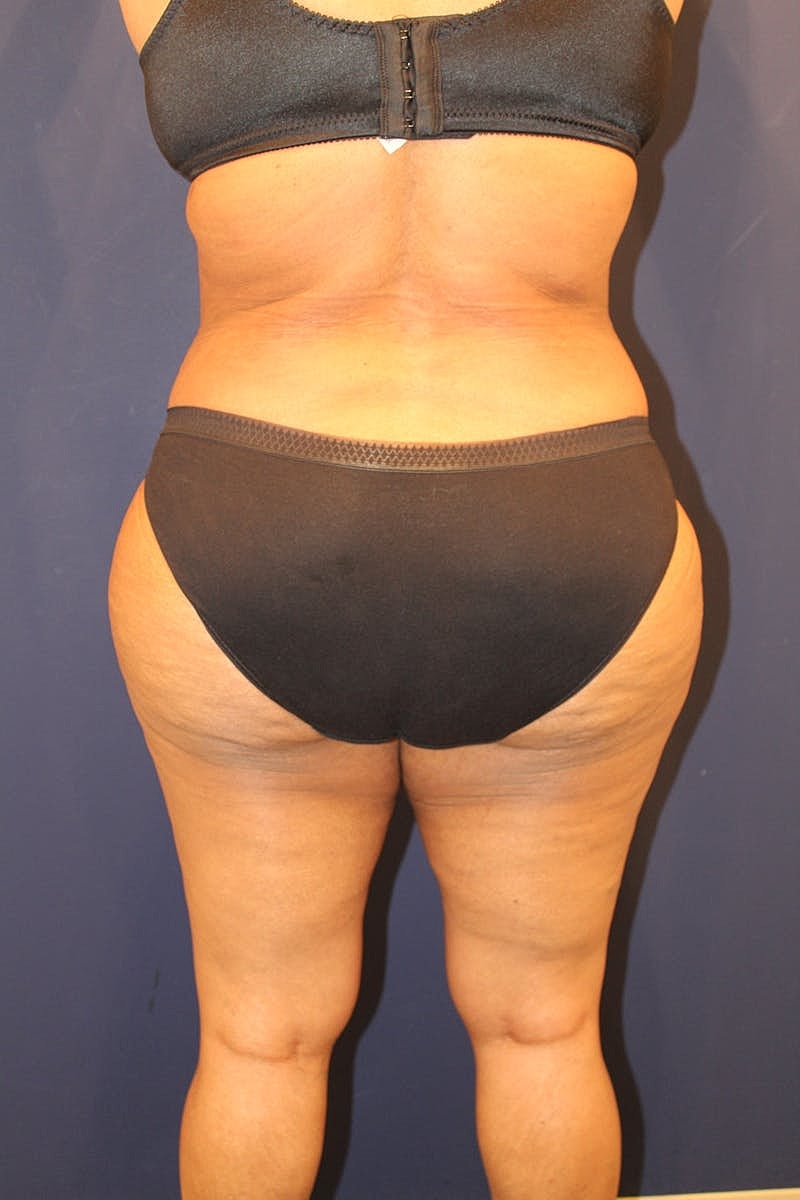 Tummy Tuck Before & After