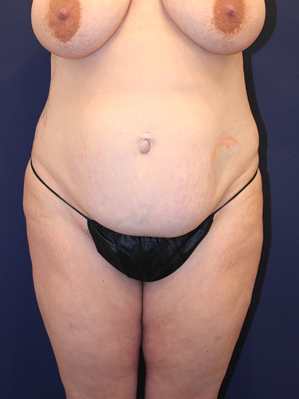 Tummy Tuck Gallery Before & After