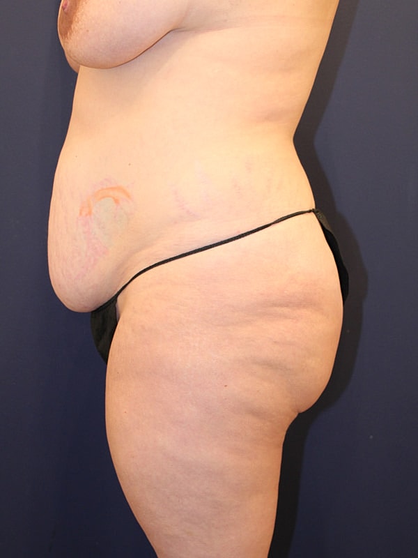 Tummy Tuck Gallery Before & After