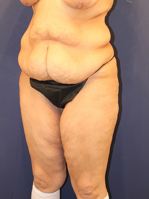 Tummy Tuck Gallery Before & After
