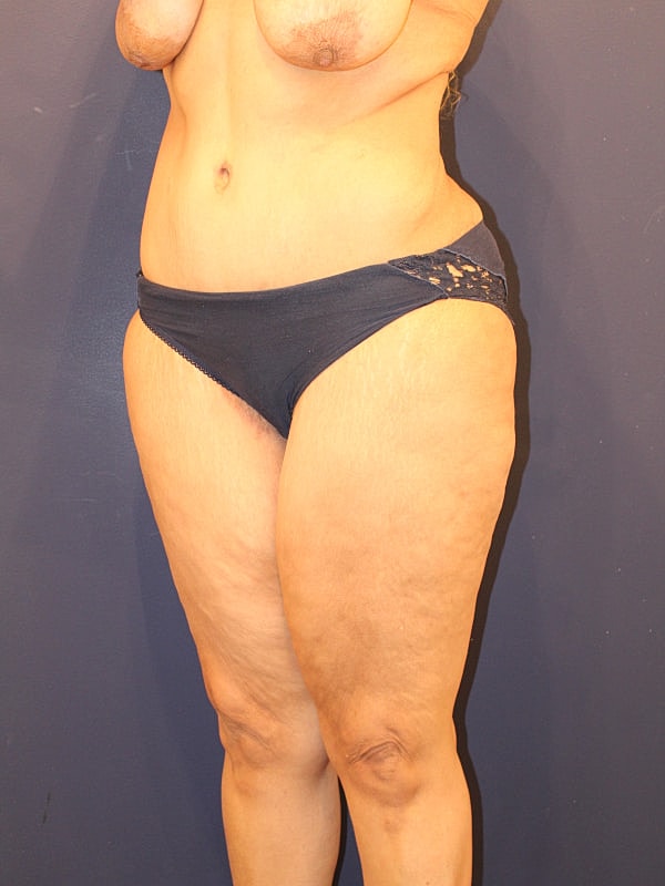 Tummy Tuck Gallery Before & After