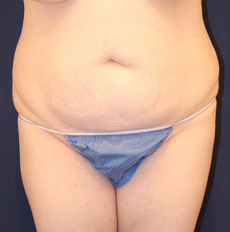 Tummy Tuck Before & After