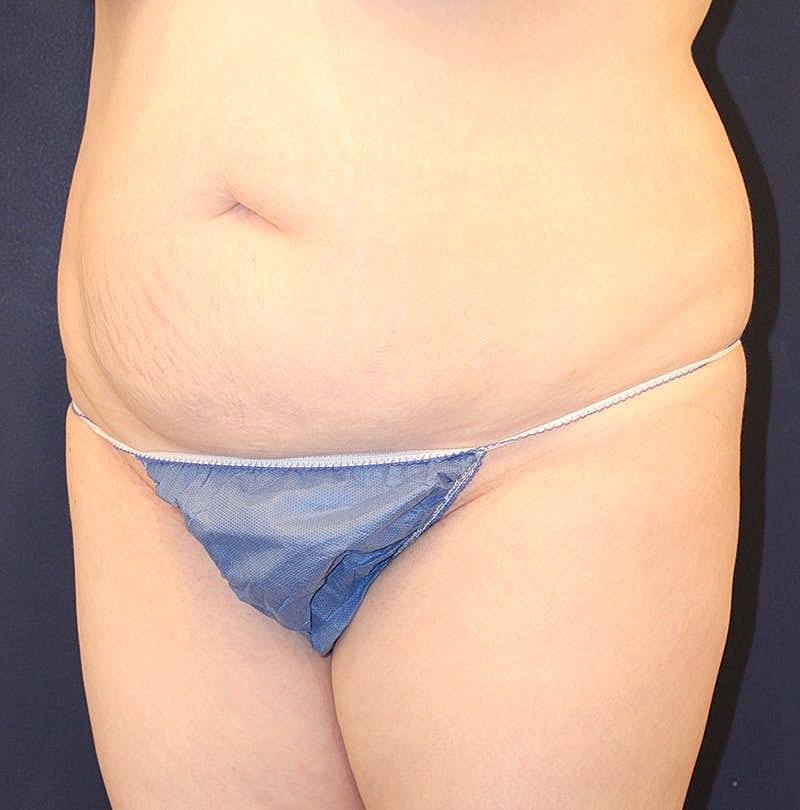 Tummy Tuck Before & After