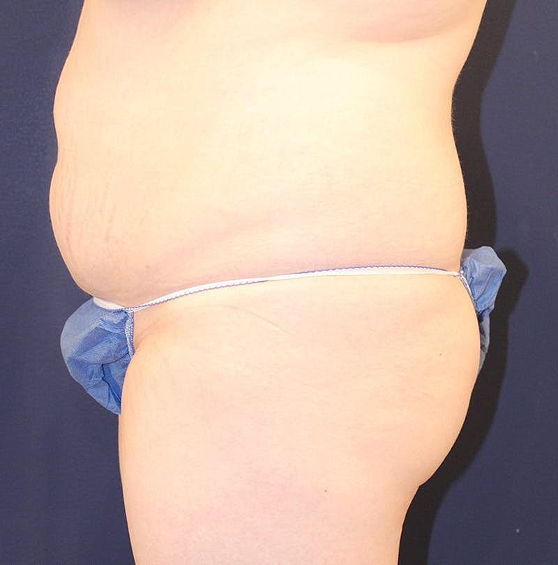 Tummy Tuck Before & After