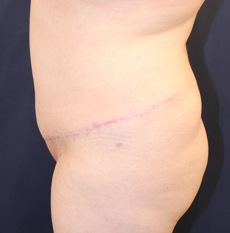 Tummy Tuck Before & After