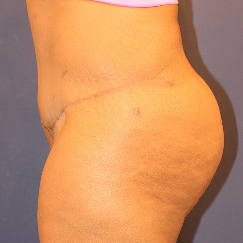 Tummy Tuck Before & After