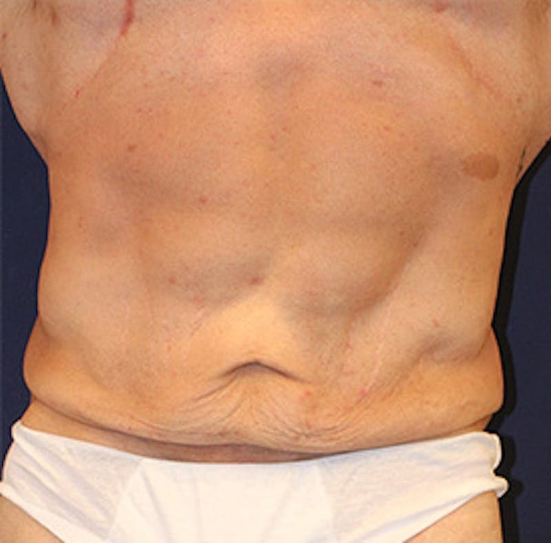 Tummy Tuck Before & After