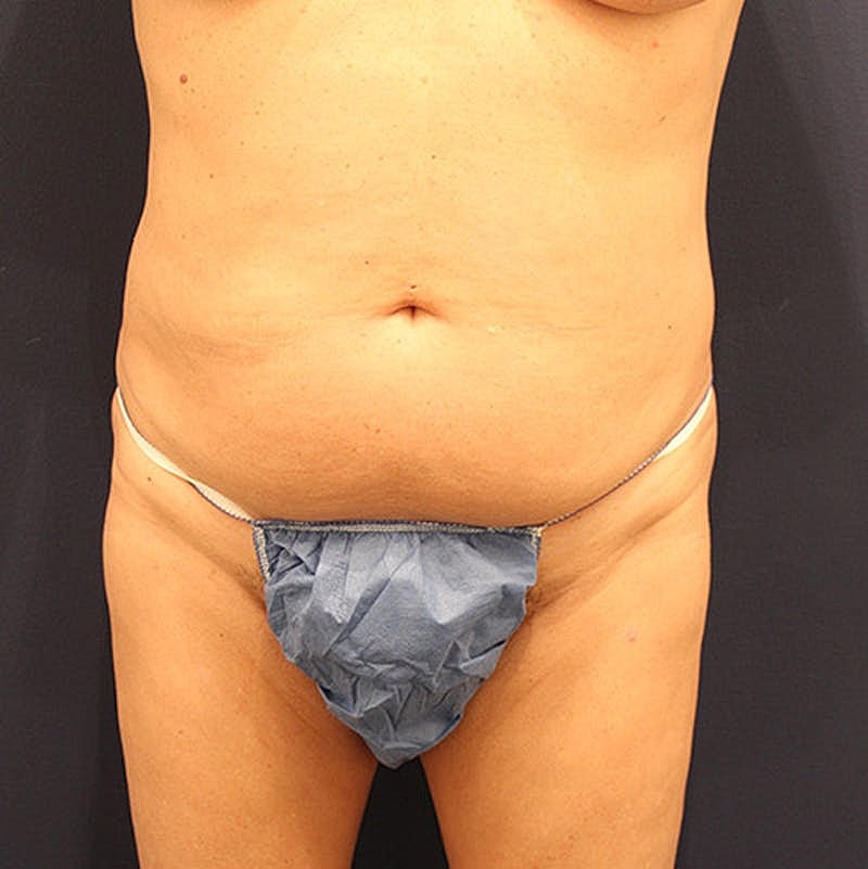 Tummy Tuck Before & After