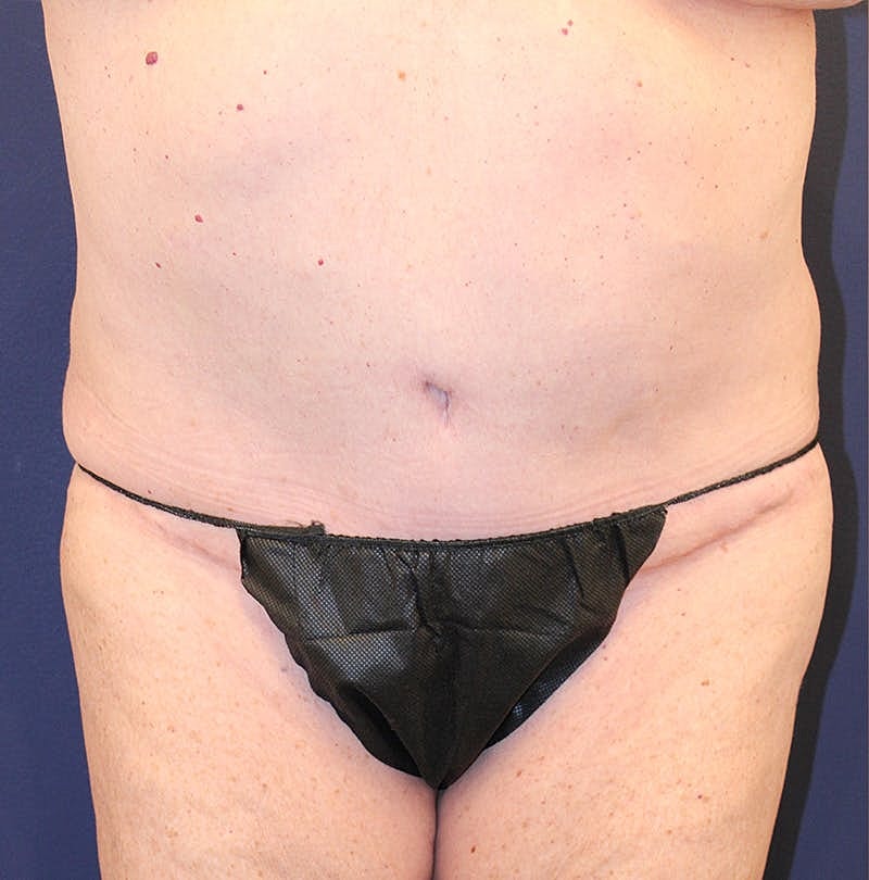 Tummy Tuck Before & After