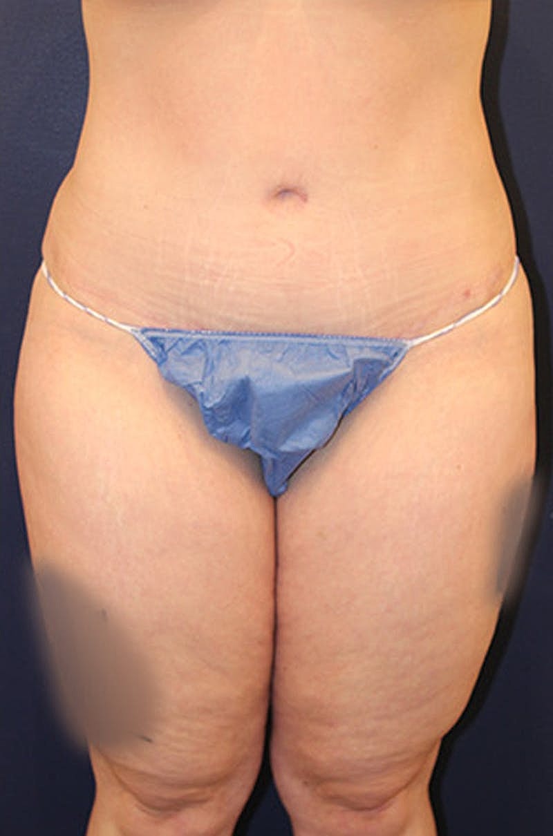 Tummy Tuck Before & After