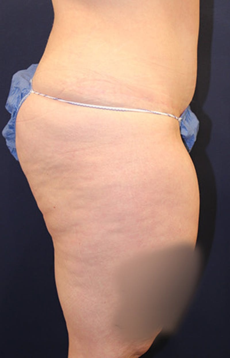 Tummy Tuck Before & After