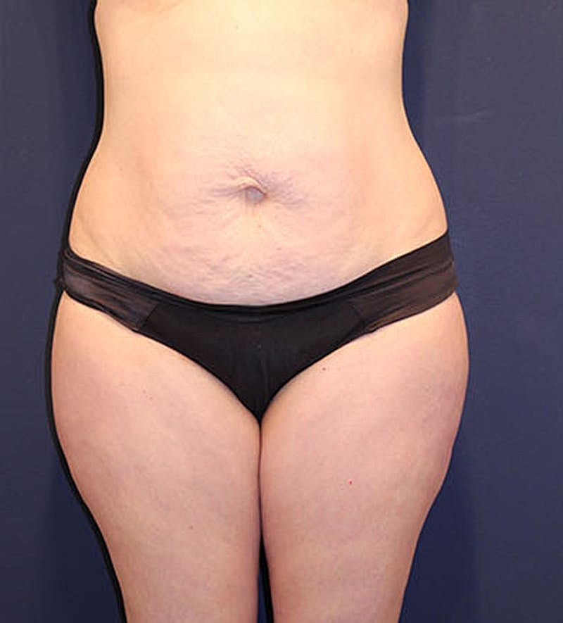 Tummy Tuck Before & After