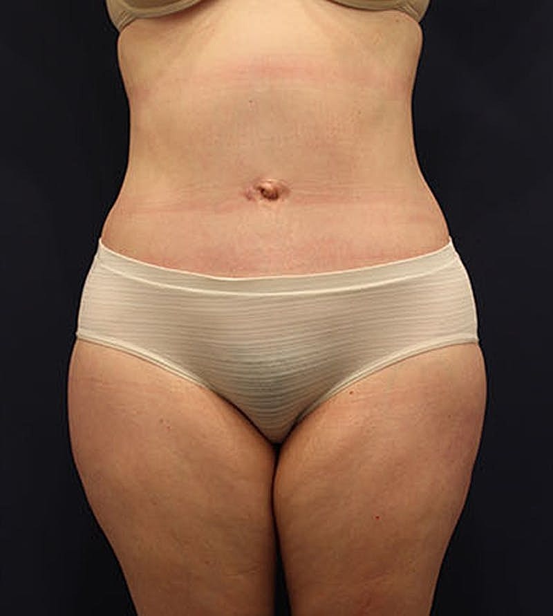Tummy Tuck Before & After