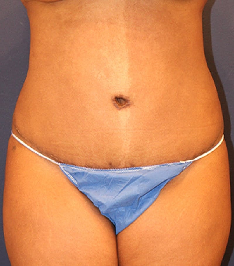Tummy Tuck Before & After