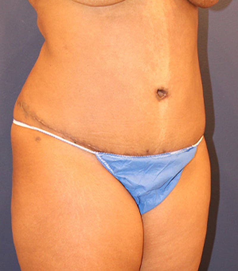 Tummy Tuck Before & After