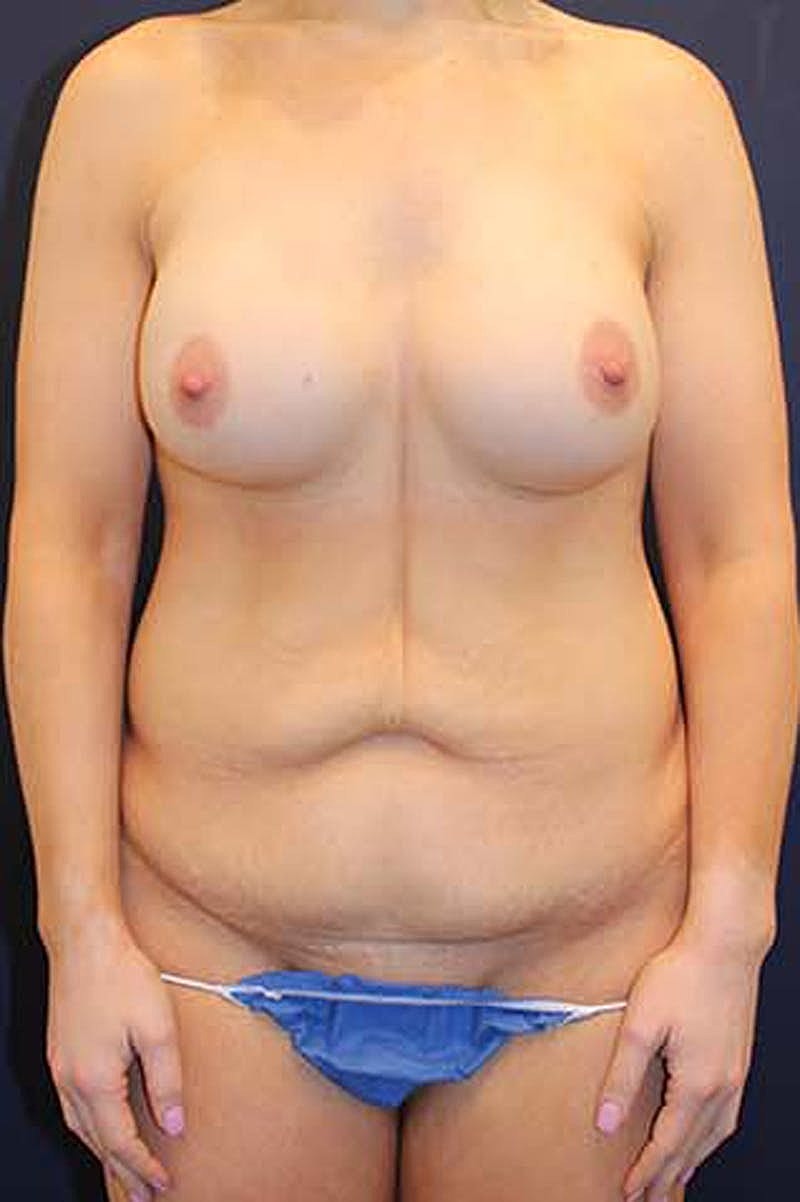Tummy Tuck Before & After