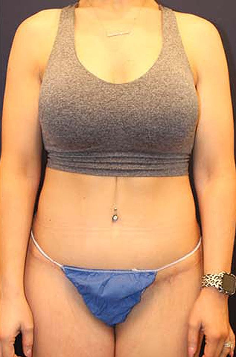 Tummy Tuck Before & After
