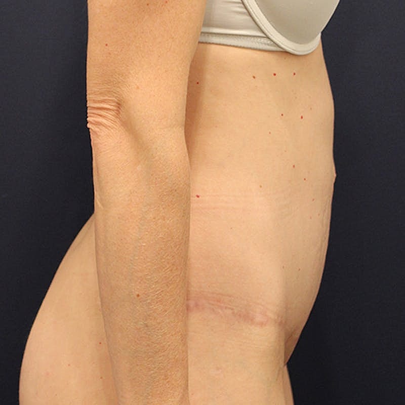 Tummy Tuck Before & After