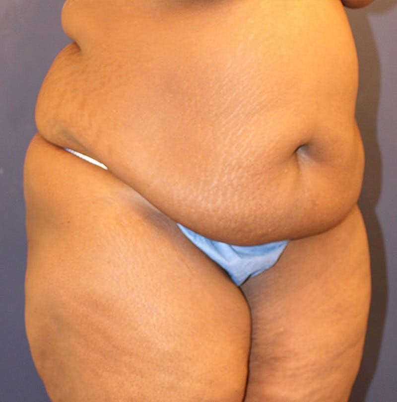 Tummy Tuck Before & After