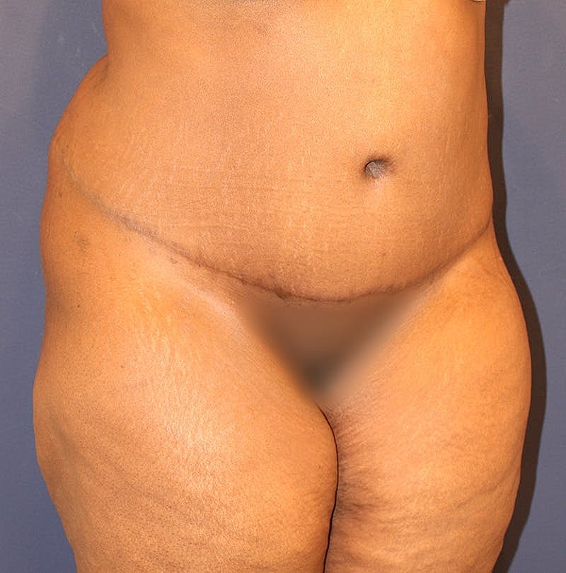 Tummy Tuck Before & After