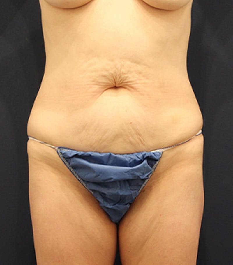 Tummy Tuck Before & After