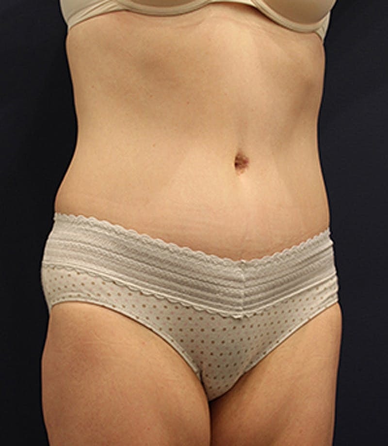 Tummy Tuck Before & After