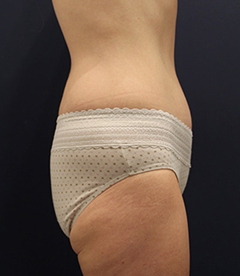 Tummy Tuck Before & After