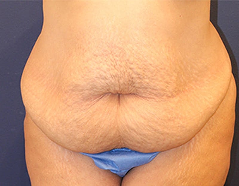 Tummy Tuck Before & After