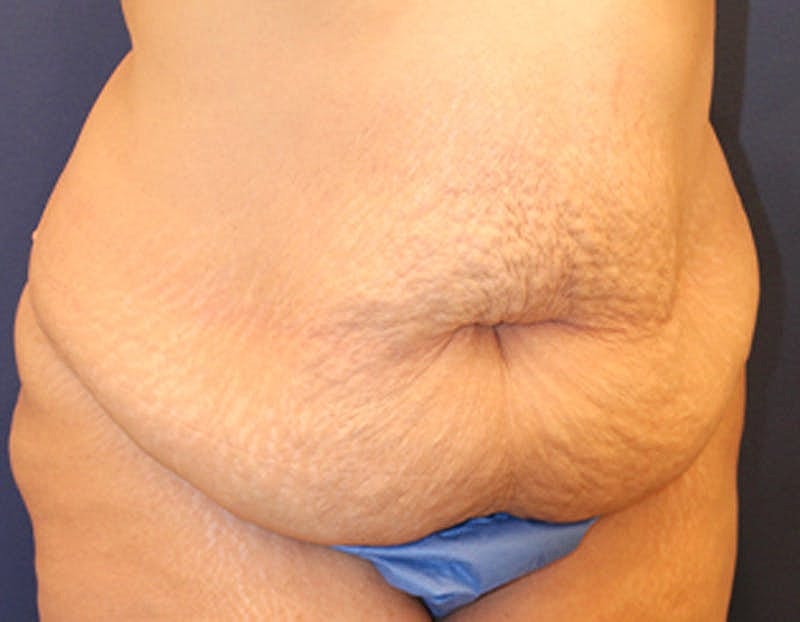 Tummy Tuck Before & After