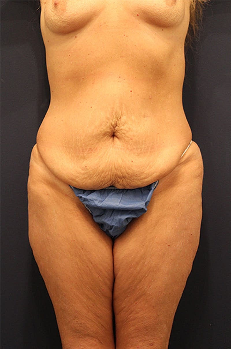 Tummy Tuck Before & After