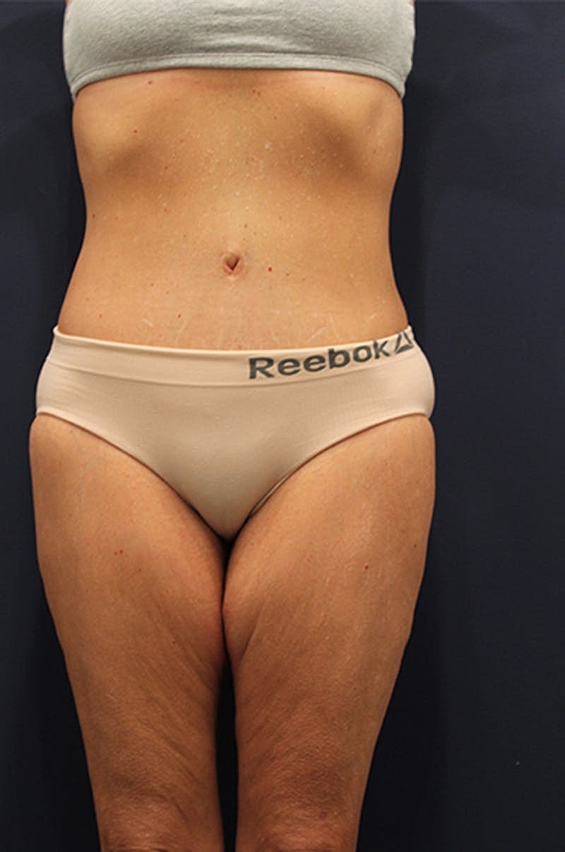 Tummy Tuck Before & After