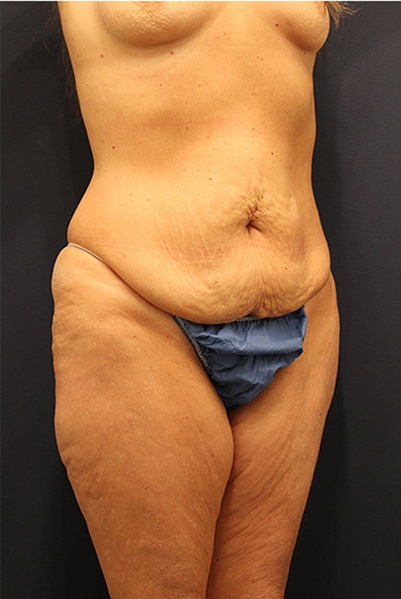 Tummy Tuck Before & After