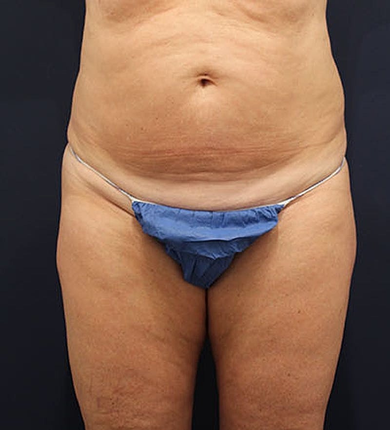 Tummy Tuck Before & After