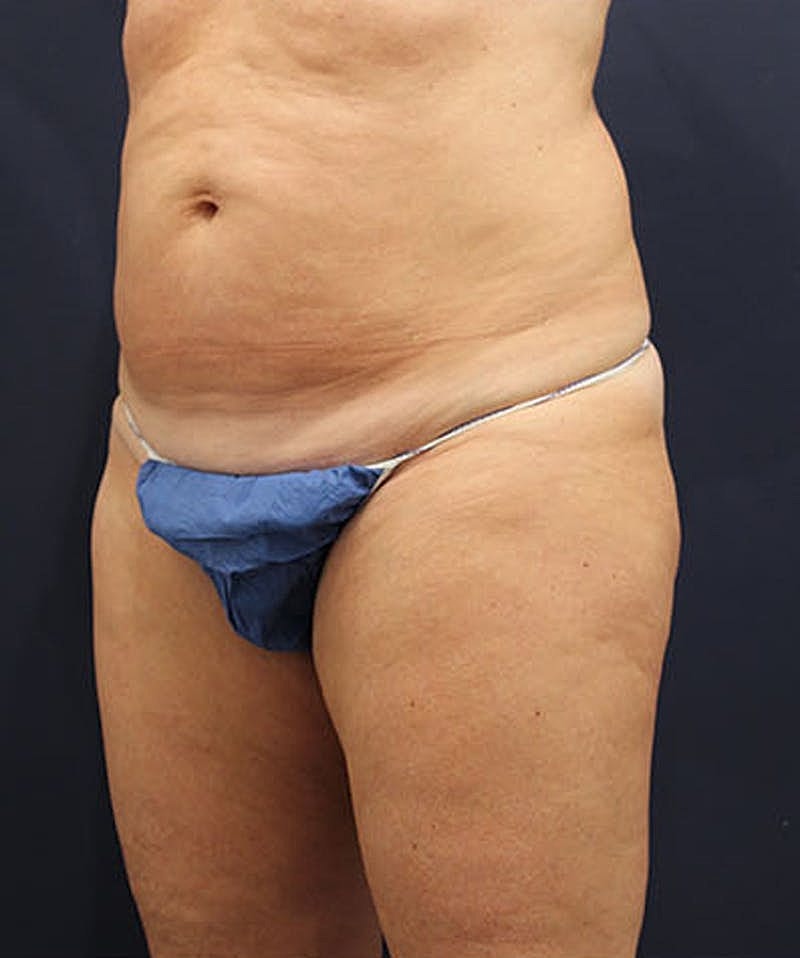 Tummy Tuck Before & After