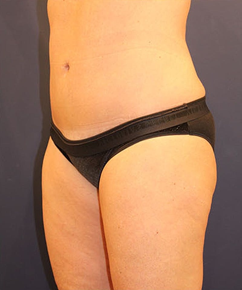 Tummy Tuck Before & After