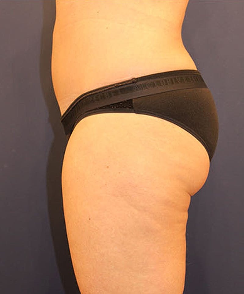 Tummy Tuck Before & After