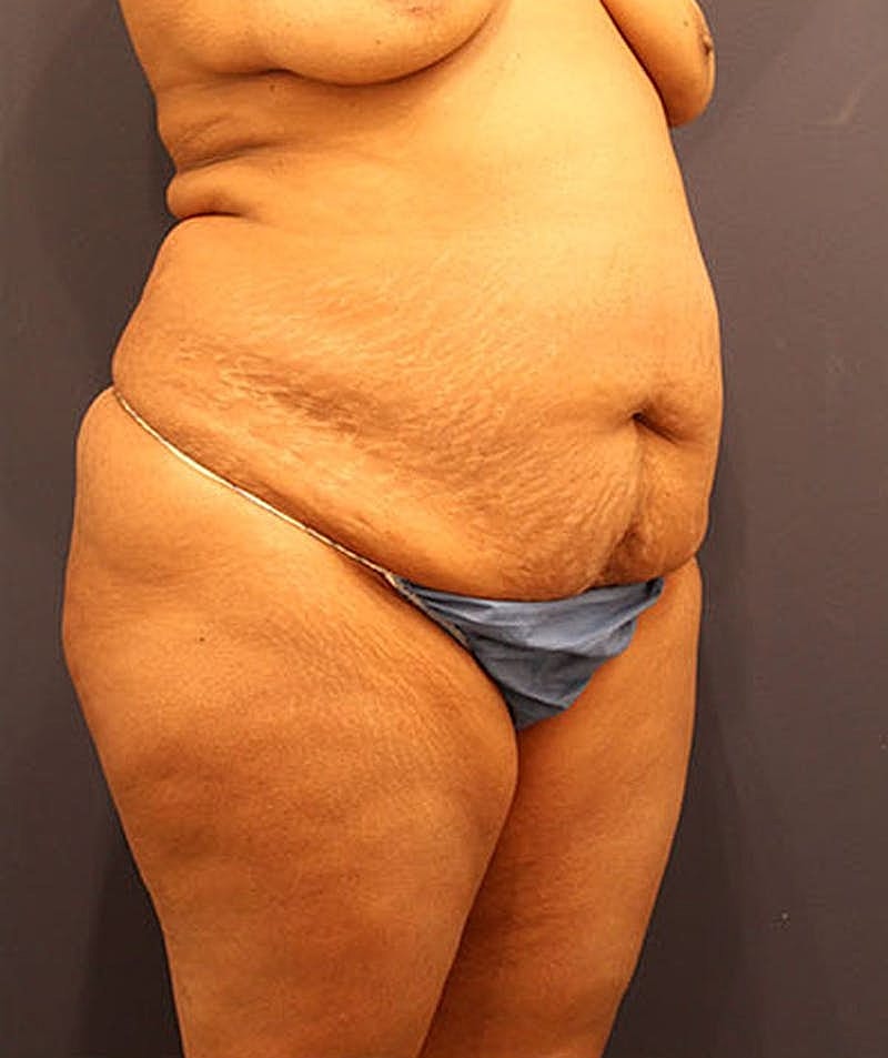 Tummy Tuck Before & After